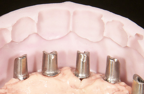 インプラント内冠