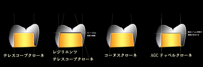 図01a_ドッペル比較1.jpg
