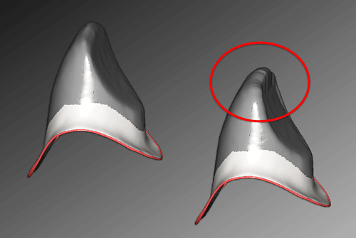 支台歯形成について 01「現在市上されているCAD/CAM用支台歯