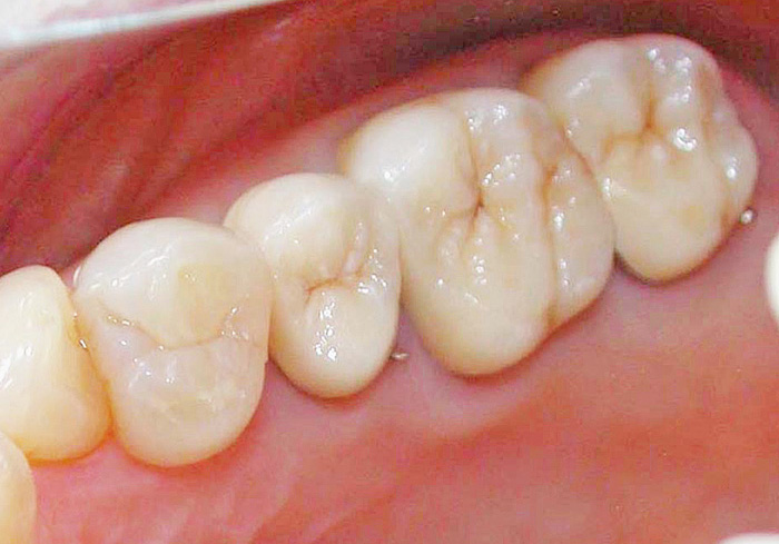 臼歯部_AGCブリッジ-b.jpg