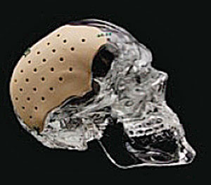 頭蓋骨インプラントの例
